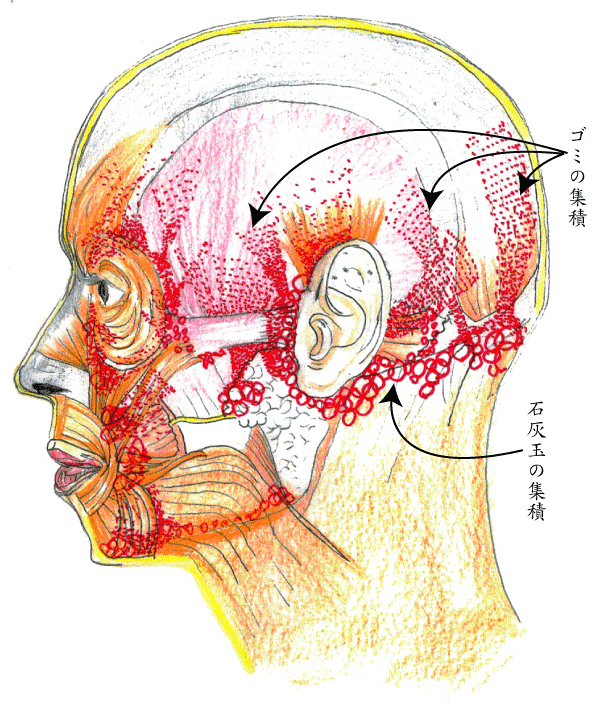 群発頭痛に見られる頭部の堆積ゴミの実況