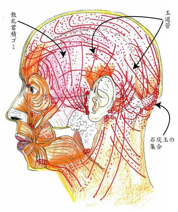 緊張型頭痛に見られる頭部の「ゴミ」と「玉道管」